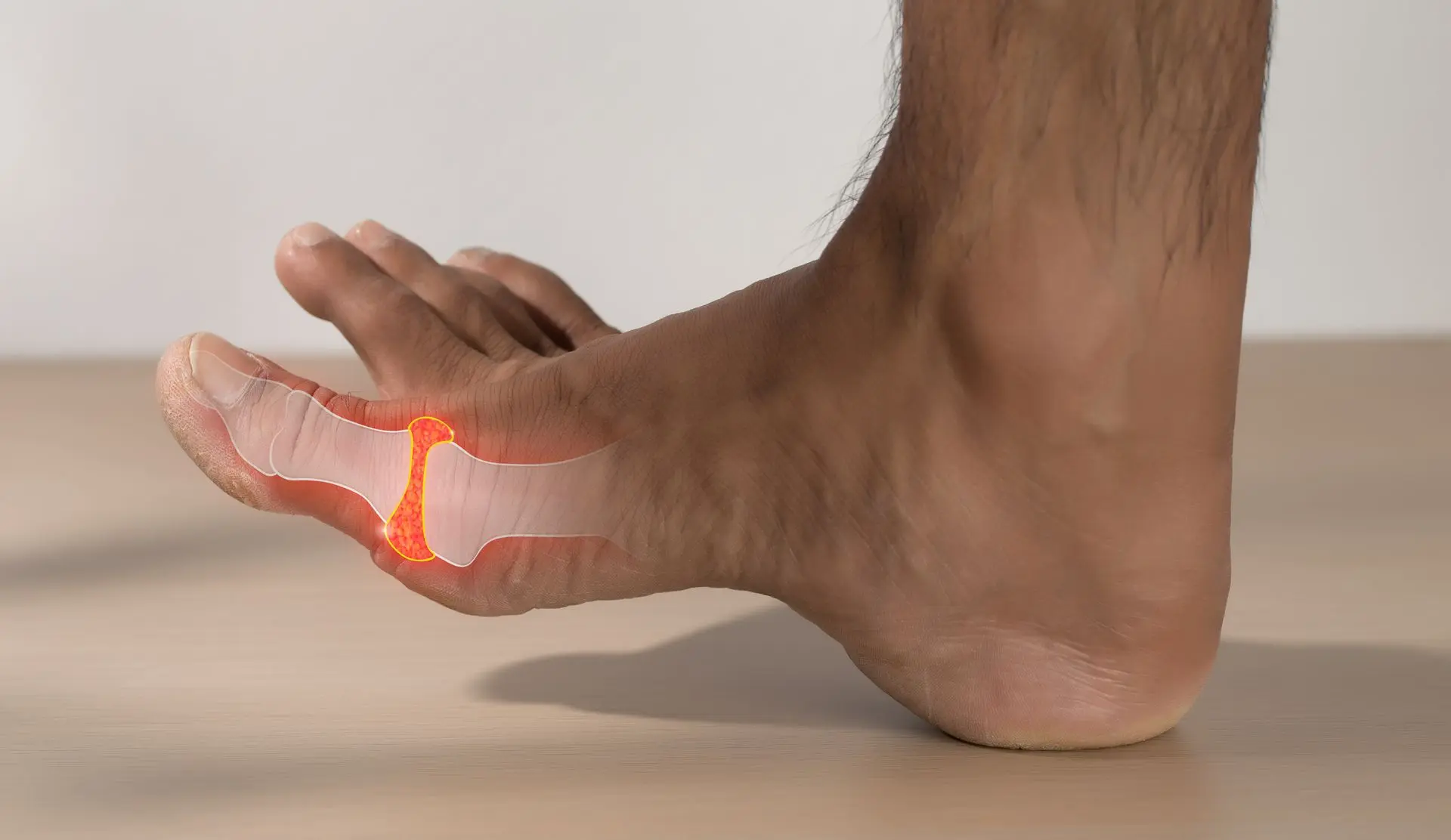 Ejemplo visual de pie con juanete (Hallux Valgus)